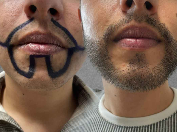 beard-transplantation