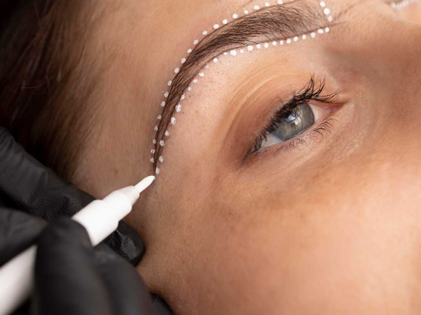 eyebrow-transplantation