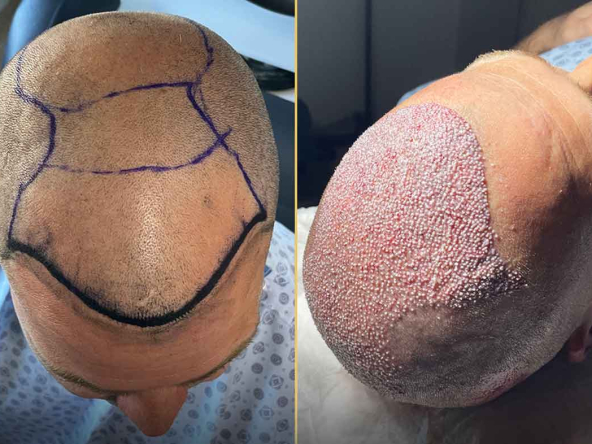 hair-transplantation-2