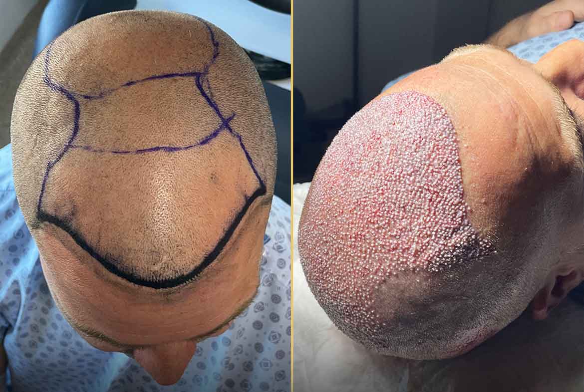 hair-transplantation-2