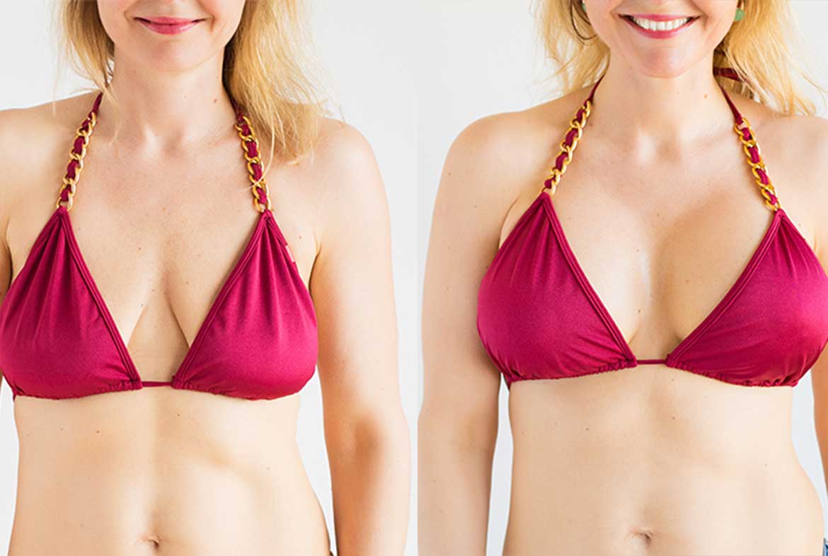 breast-lift-surgery
