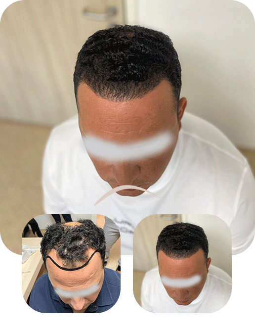 4800 grafts