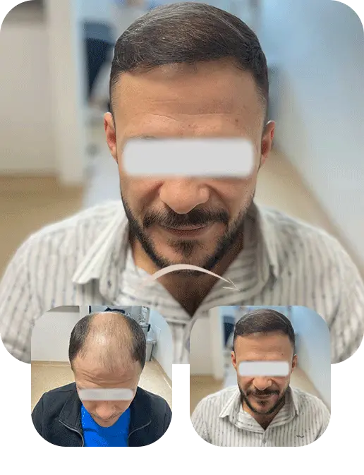 5200 grafts