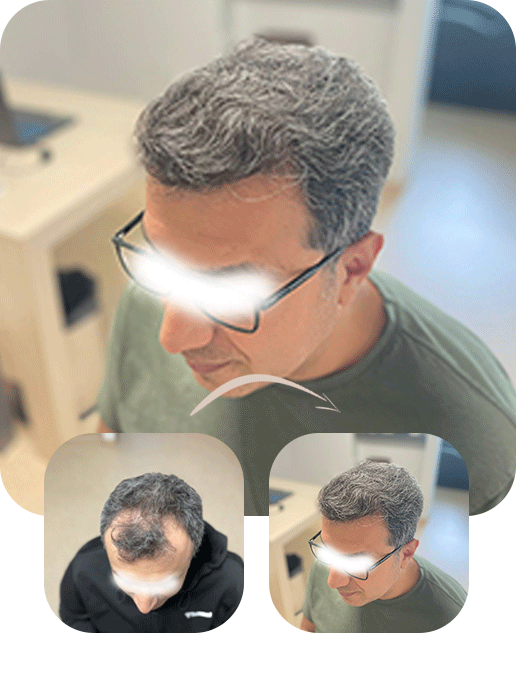 2800 grafts